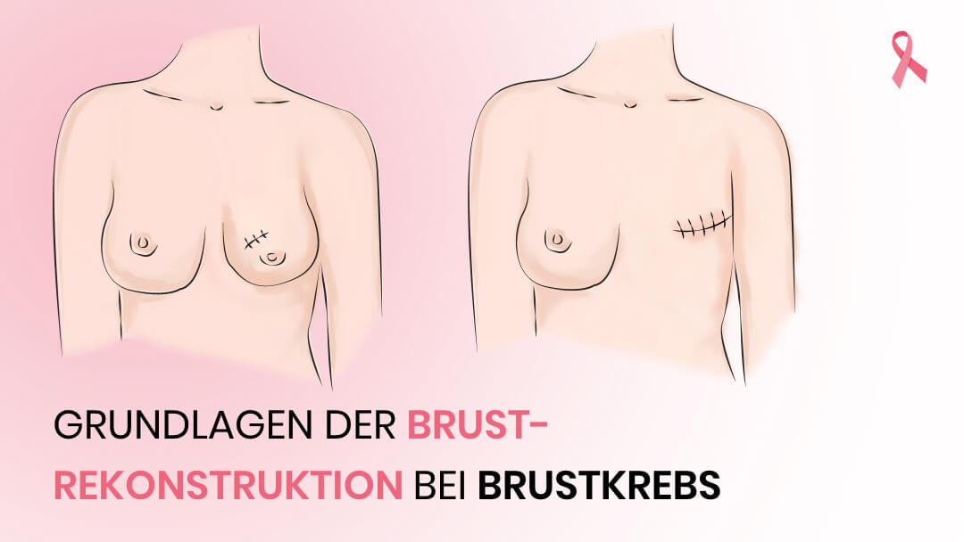 Grundlagen der Brustrekonstruktion bei Brustkrebs